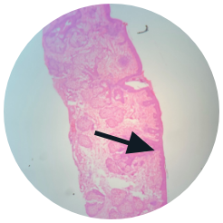 IMPROVED RESULT LUMOHS HANDLE MOHS EXCISION- Note complete epidermal smooth rounded margins