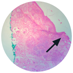 COMMON RESULT TRADITIONAL #3 MOHS EXCISION- Note torn incomplete irregular epidermal margins 